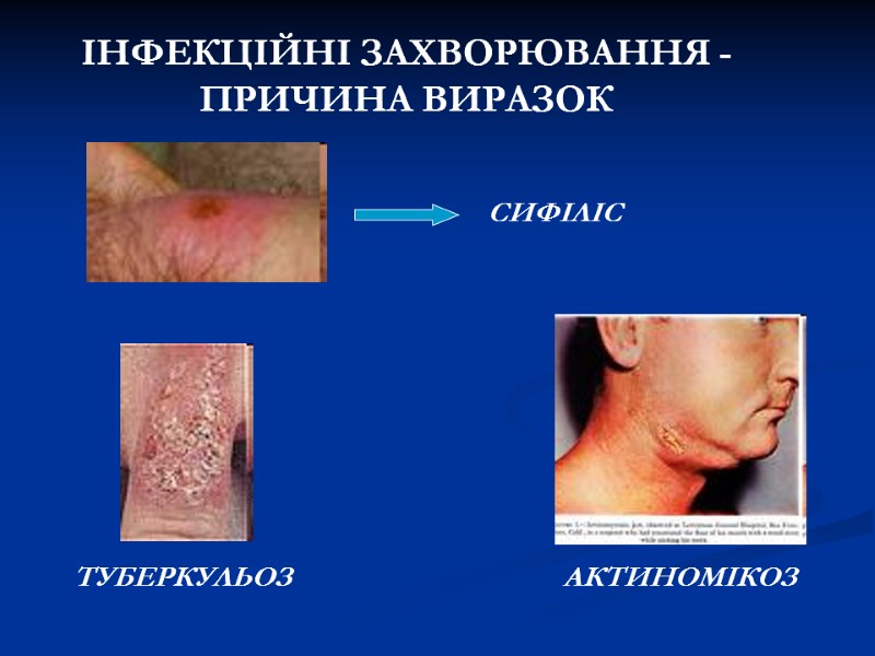 ІНФЕКЦІЙНІ ЗАХВОРЮВАННЯ - ПРИЧИНА ВИРАЗОК СИФІЛІС ТУБЕРКУЛЬОЗ АКТИНОМІКОЗ ІНФЕКЦІЙНІ ЗАХВОРЮВАННЯ - ПРИЧИНА ВИРАЗОК СИФІЛІС ТУБЕРКУЛЬОЗ АКТИНОМІКОЗ